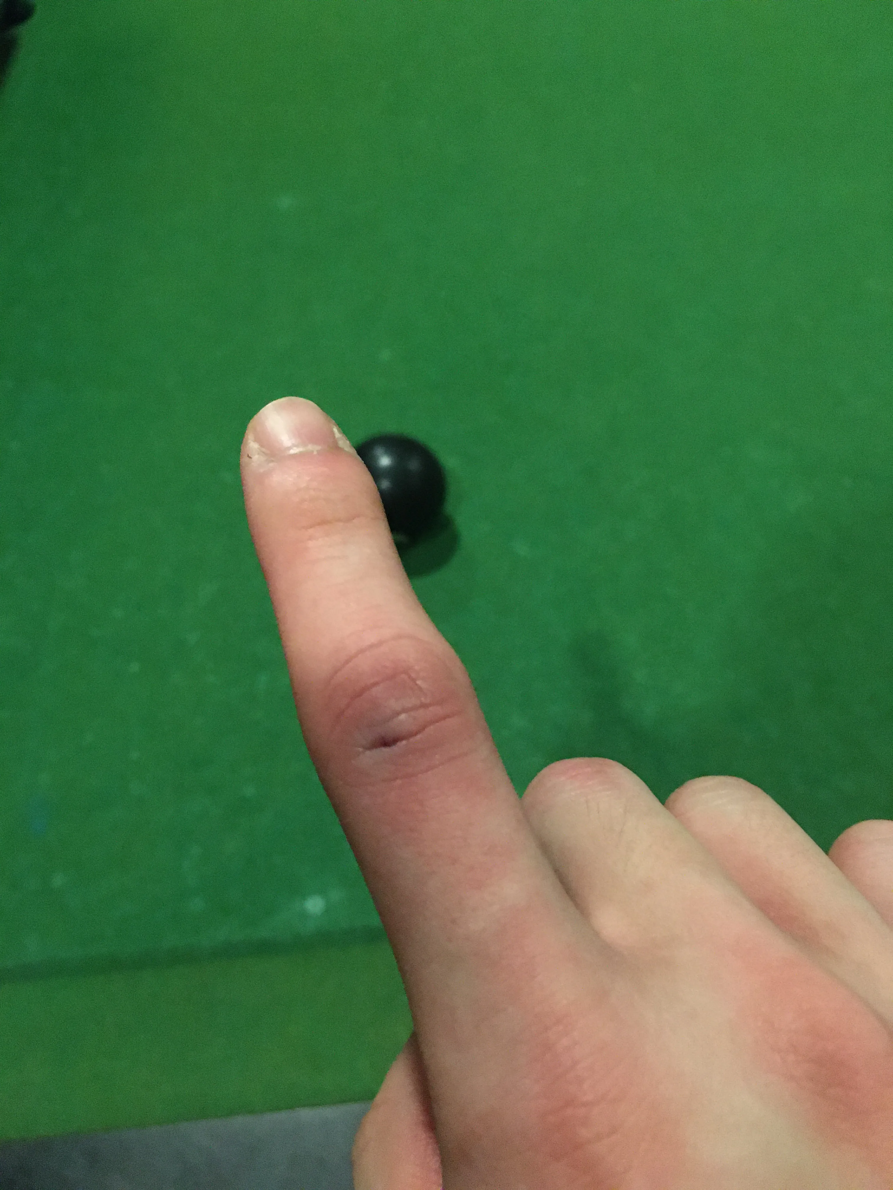 Image of my injured finger